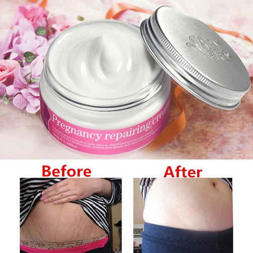 Fast Remove Stretch Marks Cream Repairing Postpartum Scar Pregnancy Obesity JE3 NW